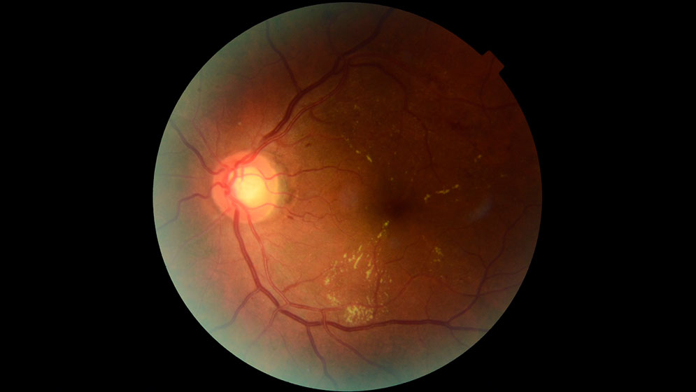 Desarrollan IA para prevenir pérdida visual en diabéticos